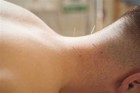 ACUPUNCTURE FOR STRESS AND ANXIETY RELIEF