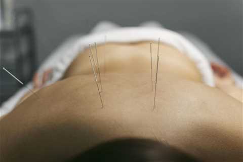 USING ACUPUNCTURE FOR CHRONIC LOWER BACK PAIN MANAGEMENT