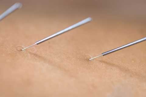 HOW TO USE ACUPUNCTURE FOR CHRONIC PAIN MANAGEMENT